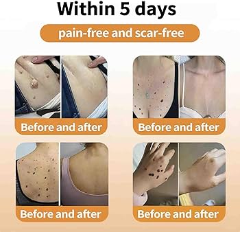 Bee Venam Wart & Mole Removel Cream