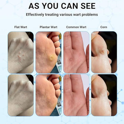 Wart Removal Cream