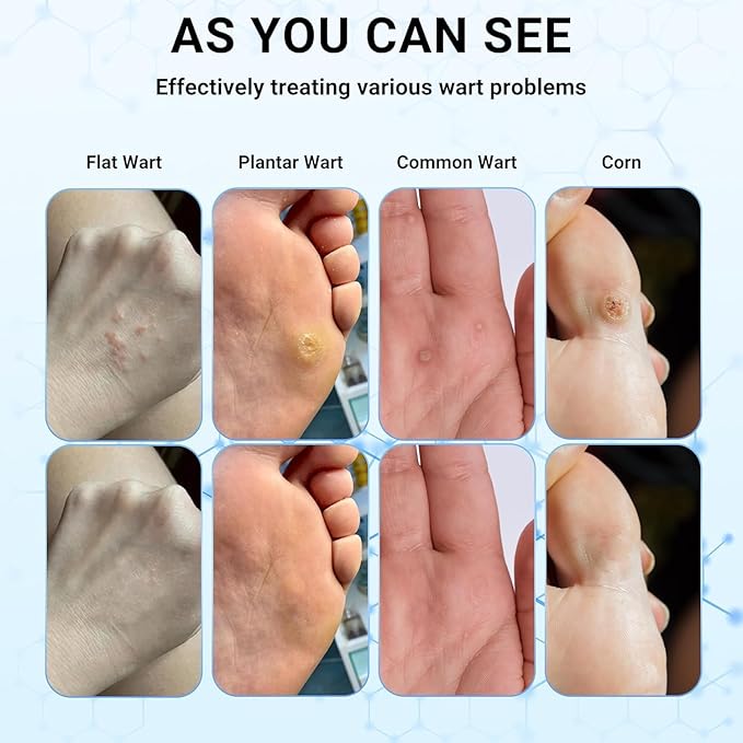 Wart Removal Cream